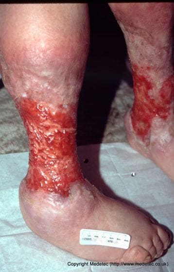 A person with some type of skin disease.