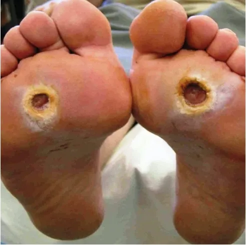 A person 's feet with an open wound on them.