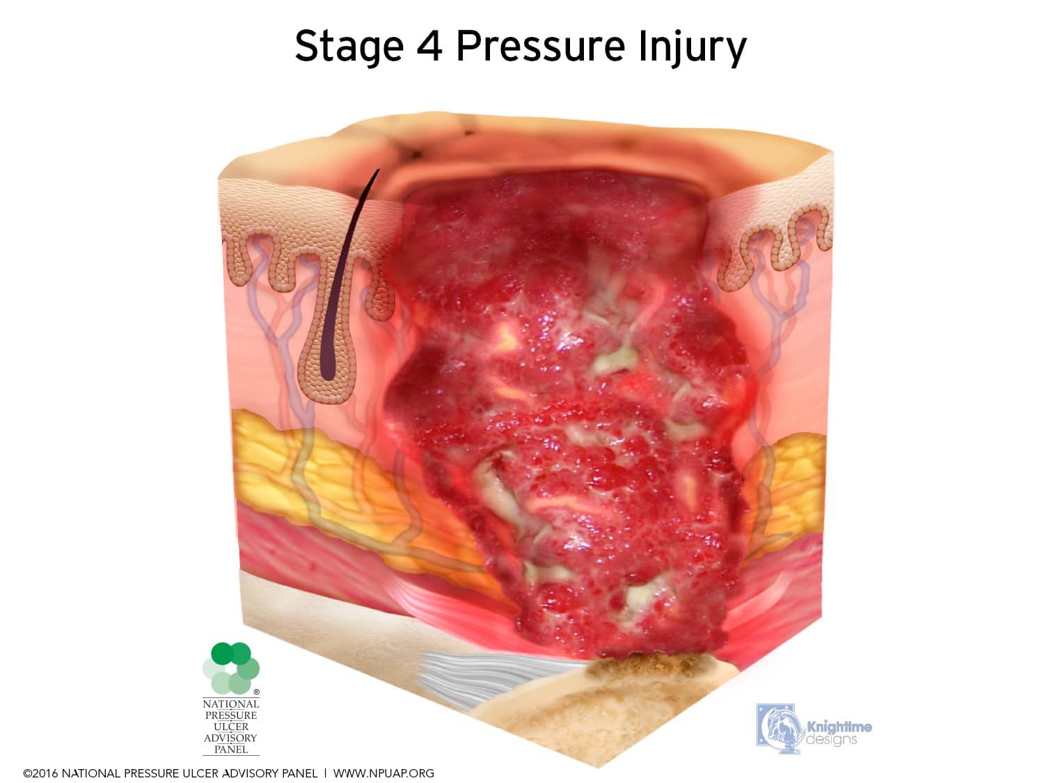 A cross section of the human body showing stage 4 pressure injury.